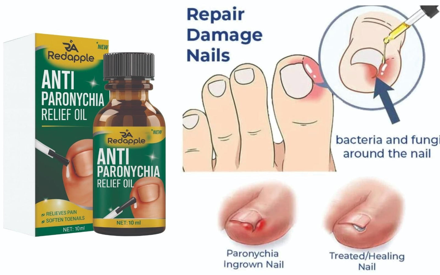 Anti Paronychia Relief Oil (20 ml) – Fast-Acting Nail & Cuticle Care | Pack of 2