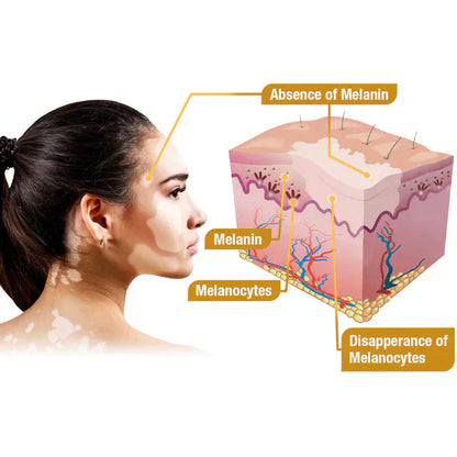 Bee Venom Vitigo Correcting Cream - (Pack of 2)